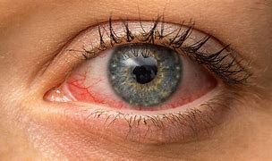Conjunctivitis (Pink Eye)