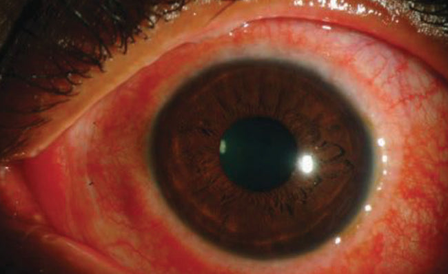 Acute Hemorrhagic Conjunctivitis |SpecSMART Eye Clinic Ikeja