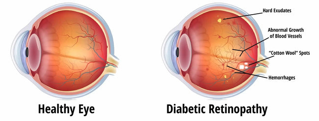 Early Diabetes Detection & Eye Care | SpecSMART Eye Clinic Ikoyi