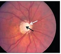 A sign of Glaucoma| SpecSMART Eye Clinic Ikeja