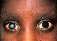 A child with cataract| SpecSMART Eye Clinic Ikeja