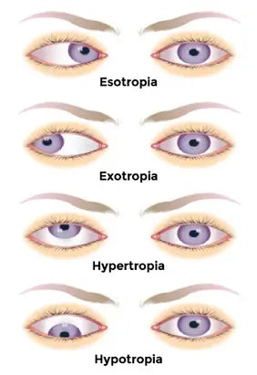 Lazy Eyes| SpecSMART Eye Clinic Ikeja