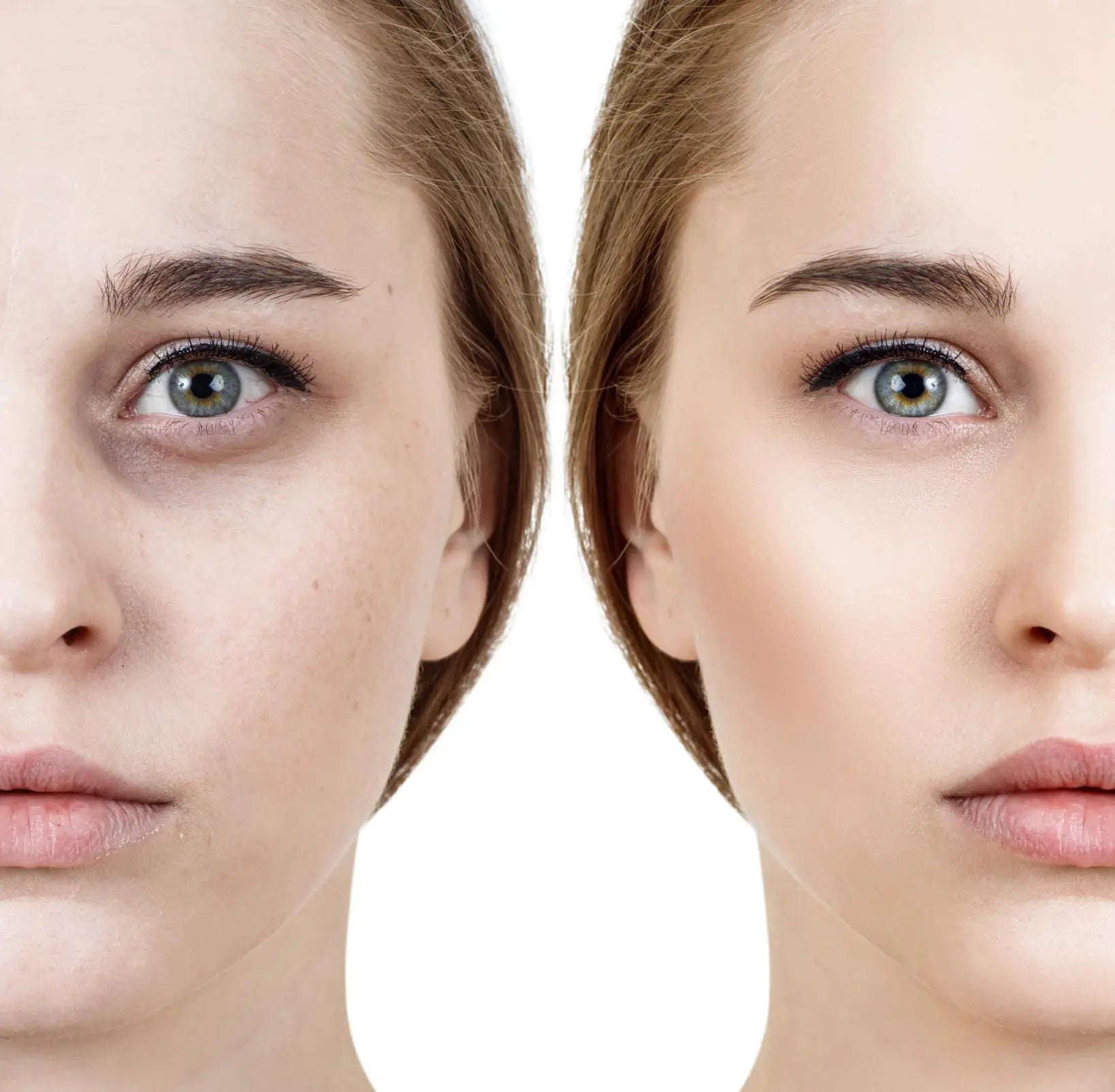 A lady with Dark Circles & Without Dark Circles| SpecSMART Eye Clinic Ikeja