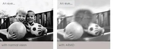 Side-by-side comparison showing normal vision versus vision affected by age-related macular degeneration (ARMD); the image on the right shows blurred central vision| SpecSMART Eye Clinic Ikoyi