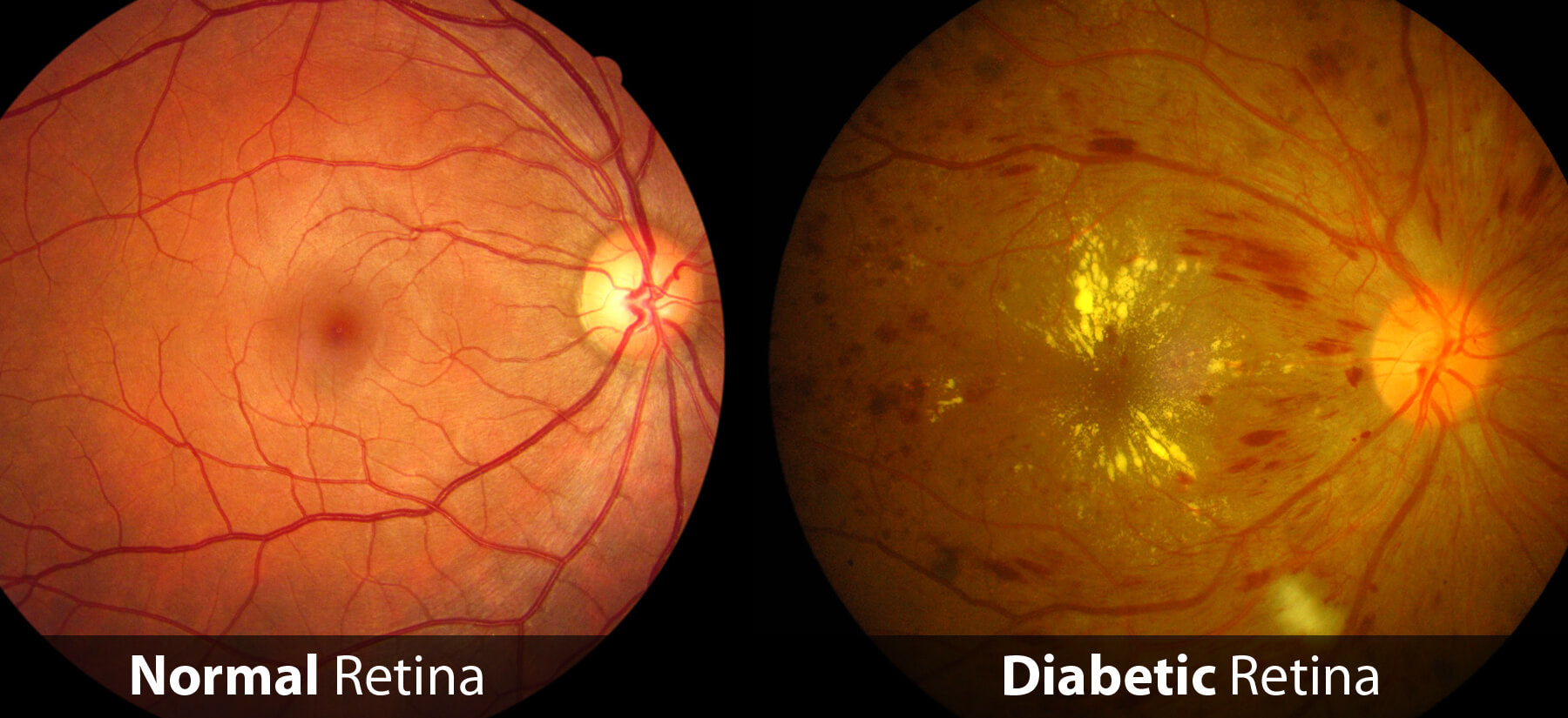 Diabetes and Eye Health: Prevention & Care |SpecSMART Eye Clinic Ikoyi