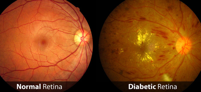 Diabetes and Eye Health: Prevention & Care |SpecSMART Eye Clinic Ikoyi