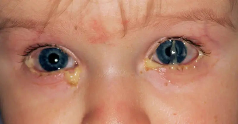 Conjunctivitis Causes & Treatment | Eye Care at SpecSMART Ikeja