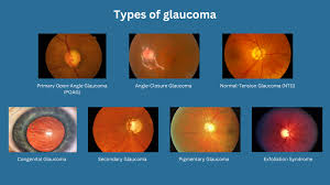 Types of glaucoma