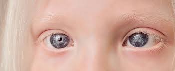 The Role of Genetics in Paediatric Eye Disorders | SpecSMART Eye Clinic Ikeja