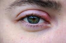 Swollen, red upper eyelid showing signs of a stye| SpecSMART Eye Clinic