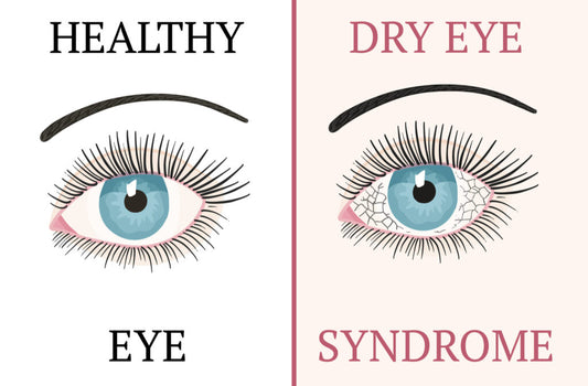 THE SCIENCE OF TEARS; UNDERSTANDING DRY EYES SYNDROME
