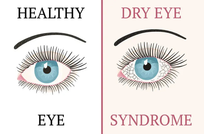 An Image Showing difference between Dry & Healthy Eye| SpecSMART Eye Clinic Ikeja