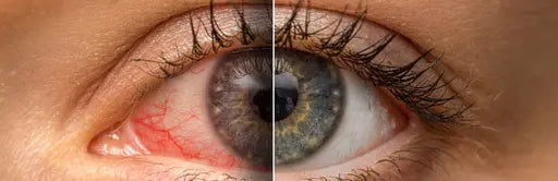 Close up of an eye with infection | SpecSMART Eye Clinic, Ikoyi Lagos