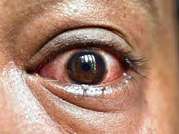 Close Up of eye | SpecSMART Eye Clinic Ikoyi
