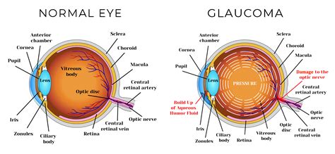 Early Signs of Glaucoma | SpecSMART Eye Clinic Ikoyi 