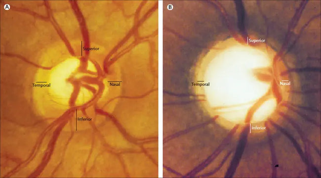 Comparison of healthy (A) and glaucomatous (B) optic nerves with labeled regions| SpecSMART Eye Clinic Ikeja