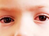 A baby with  Eye infection| SpecSMART Eye Clinic Ikeja