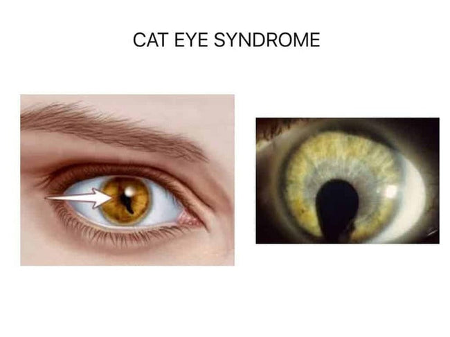 Symptoms for cat eye syndrome| SpecSMART Eye Clinic Ikeja