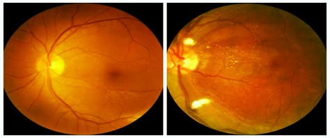 Eye illustration showing effects of hypertensive retinopathy on retinal blood vessels| SpecSMART Eye Clinic Ikeja