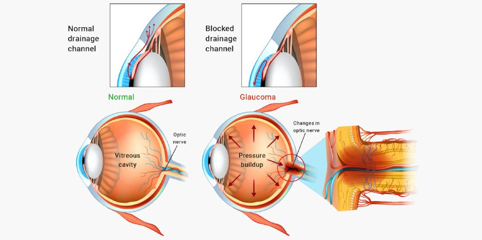 Glaucoma vision