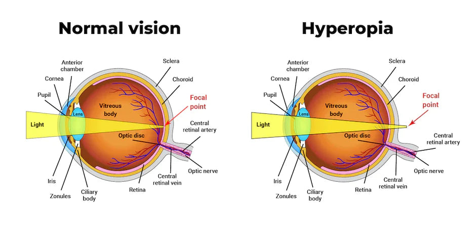 Hyperopia_long-sightedness - SpecSMART
