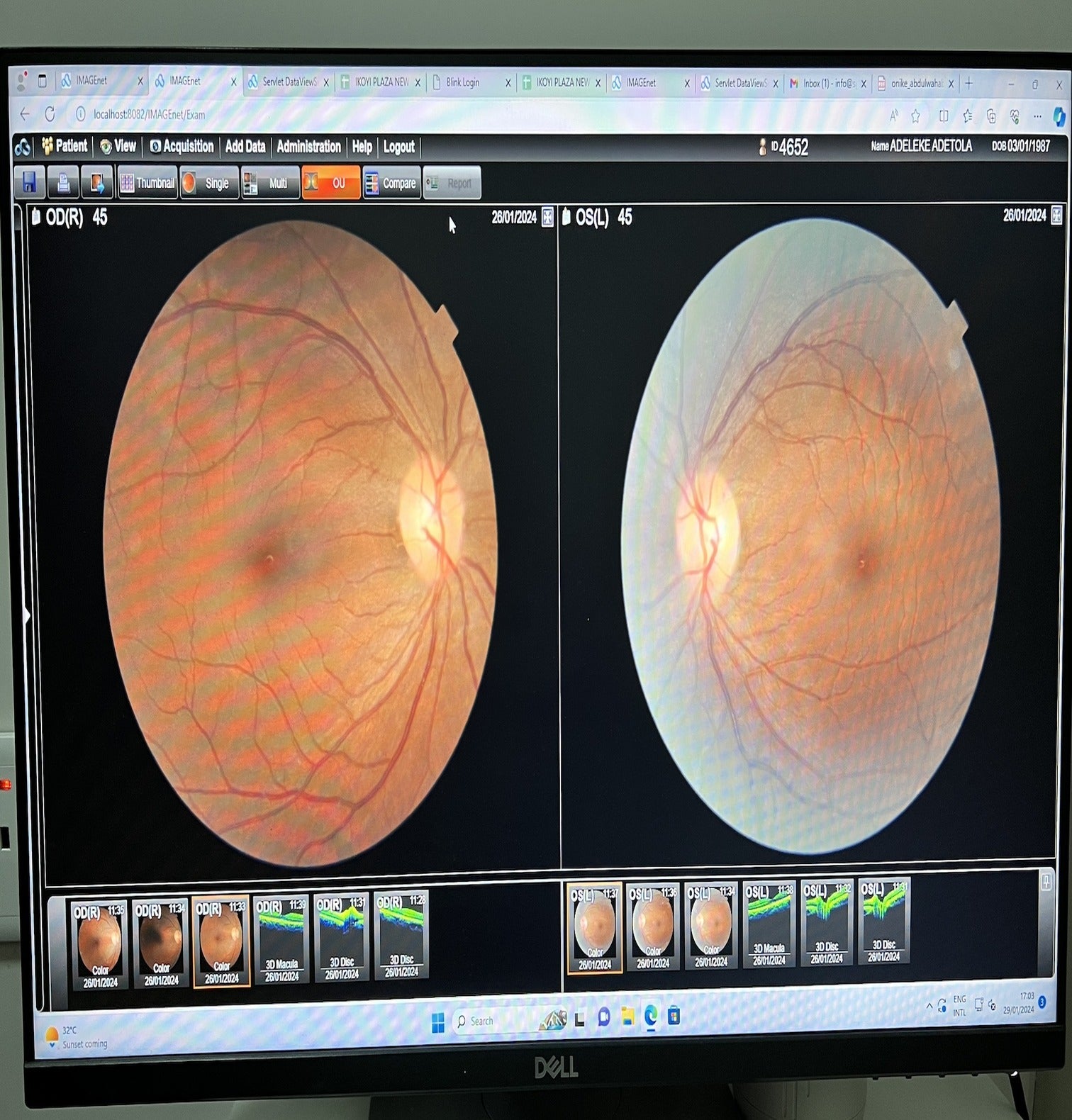 Eye test result prescription discussion - SpecSMART eye clinic