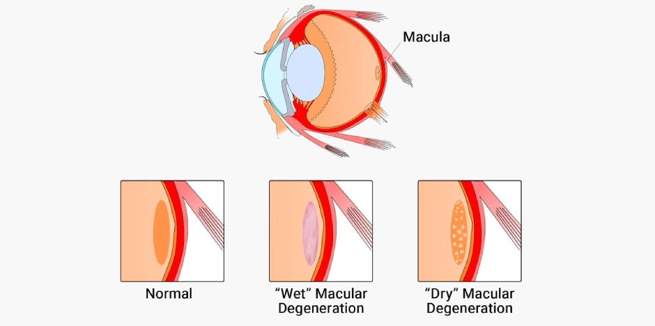 Diabetic eye disease