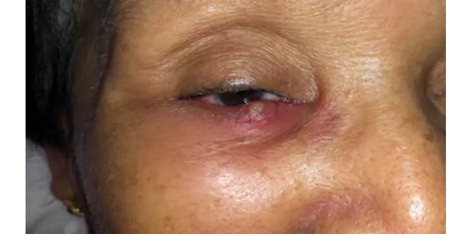 Blepharatis vision issue